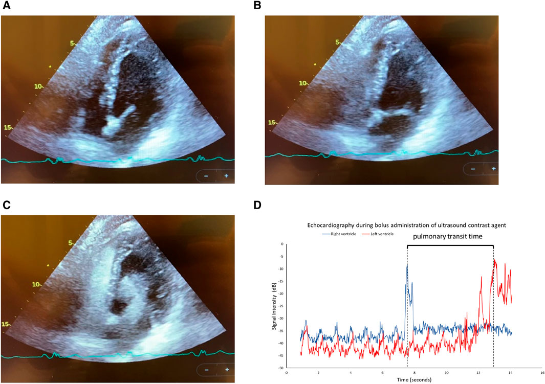 Pulmonary vascular adaptations to hypoxia in elite breath-hold divers